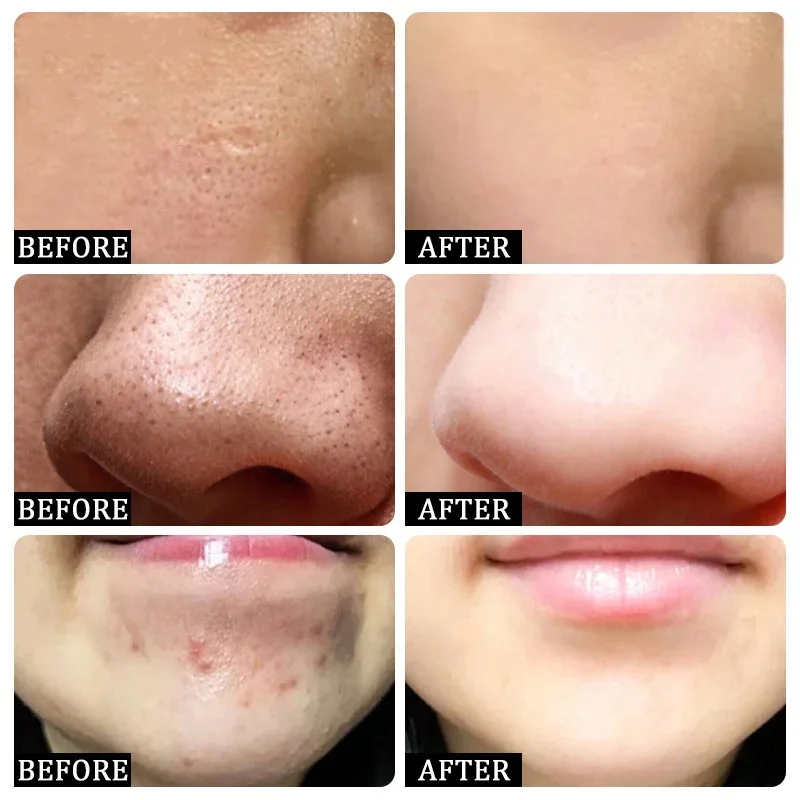Salicylic Acid Pore Clearing C - Azelaic Acid Cream review and price