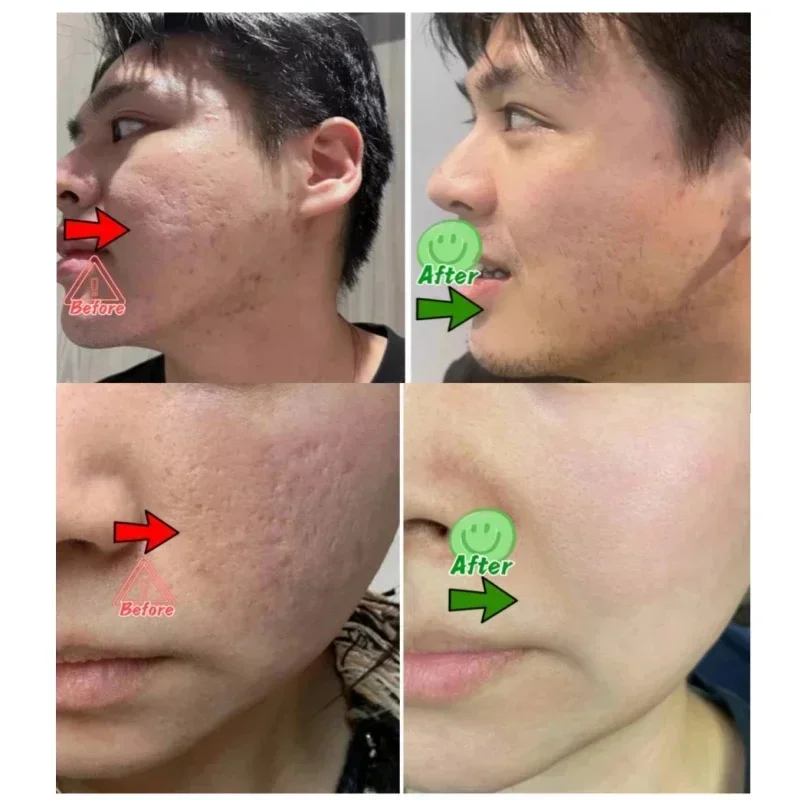 Salicylic Acid Pore Clearing C - Azelaic Acid Cream review and price