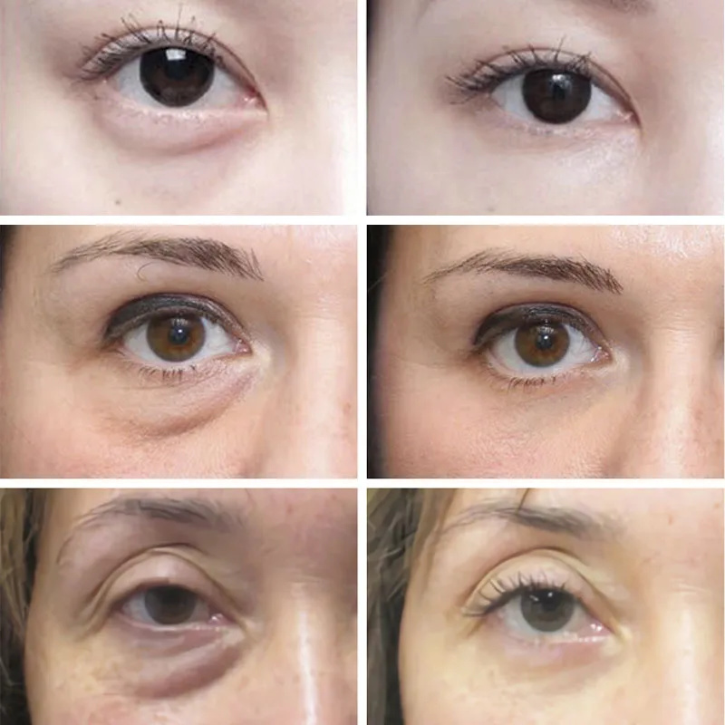 Anti Wrinkle Anti Dark Circle  - Skincare D'Alba review and price
